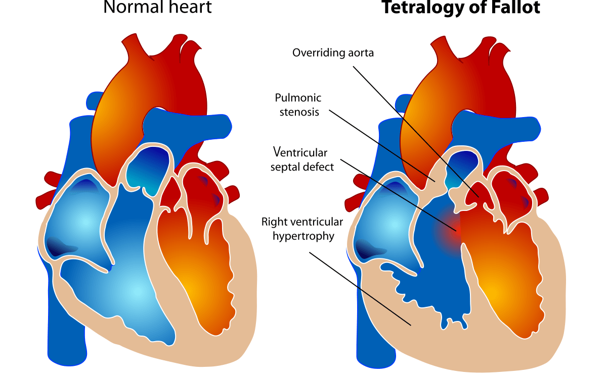 A diagram showing normal heart structure compared to a heart with Tetralogy of Fallot