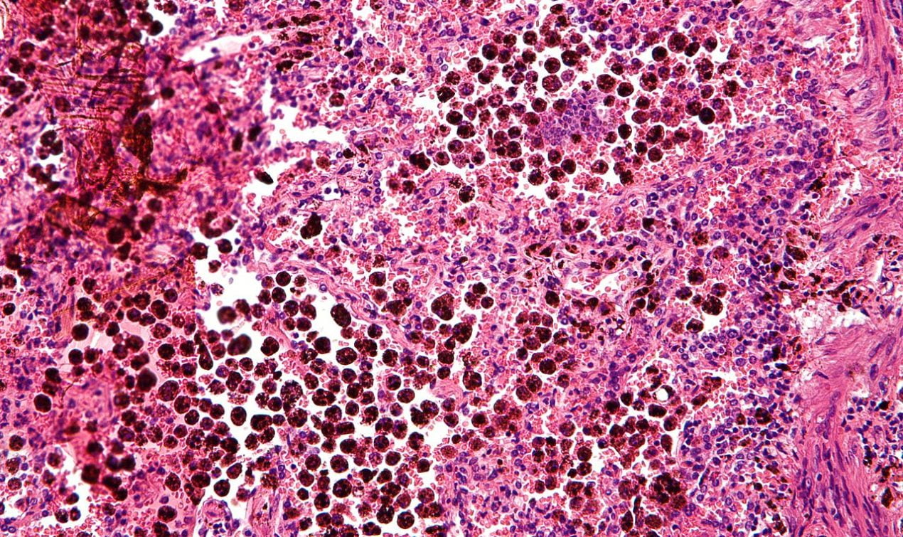 Bleeding or Hemorrhage: Classification. Micrograph showing abundant hemosiderin-laden alveolar macrophages (dark brown), as seen in a pulmonary hemorrhage. H&E stain.