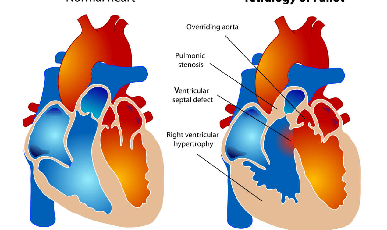 A diagram showing a healthy heart and one suffering from the tetralogy of Fallot, which constitutes four different malformations.