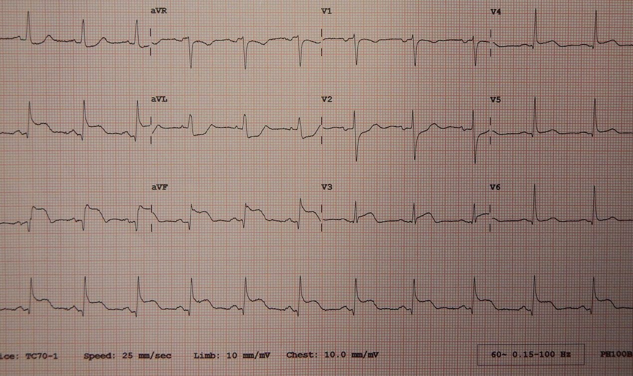 Myocardial Infraction