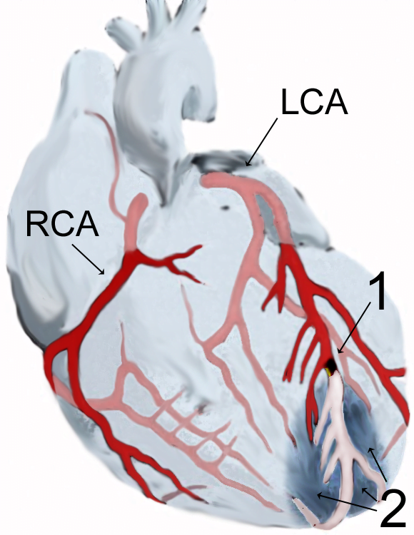 Myocardial Infraction