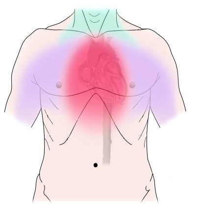 Diagram of discomfort caused by coronary artery disease. Pressure, fullness, squeezing, or pain in the center of the chest. You can also feel neck, jaw, shoulders, back, or arms discomfort.
