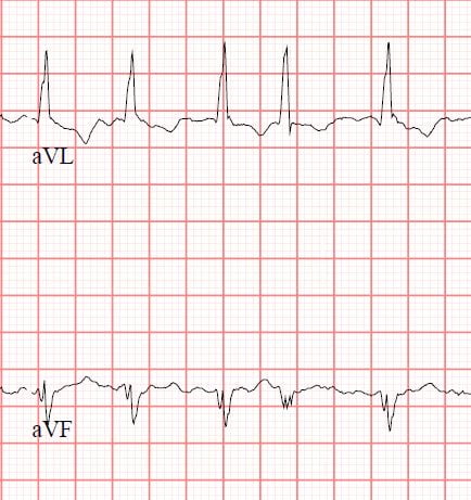 Two leads from a 12-lead ECG showing Atrial Fibrillation