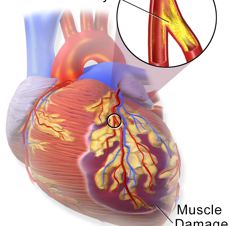 Myocardial Infarction or Heart Attack