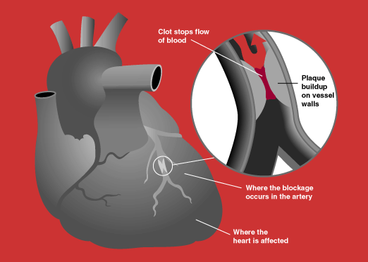 Acute coronary syndrome