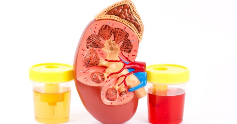 A Comprehensive Guide to Painless Hematuria: Unraveling the Mysteries
