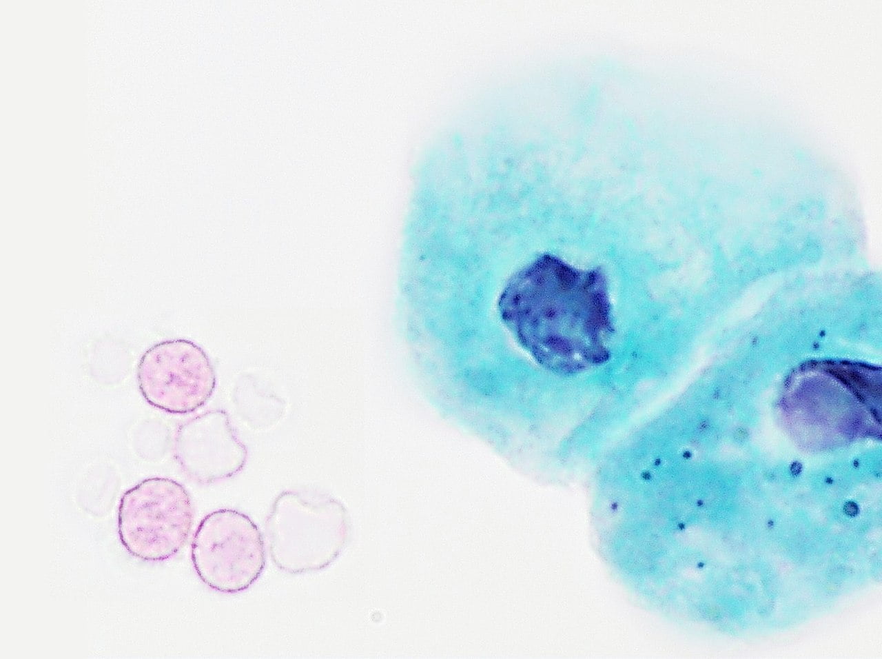 hematuria-20-potential-causes-of-blood-in-urine-without-pain