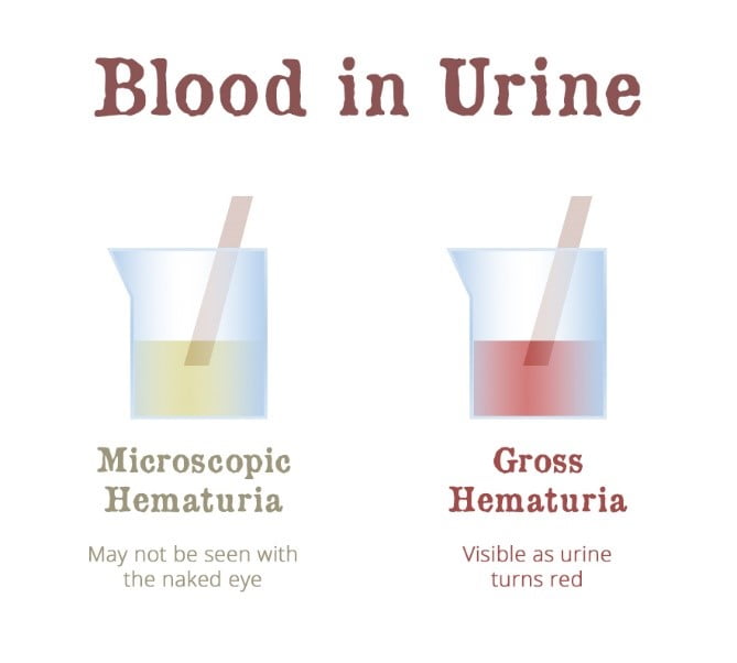 hematuria symptoms