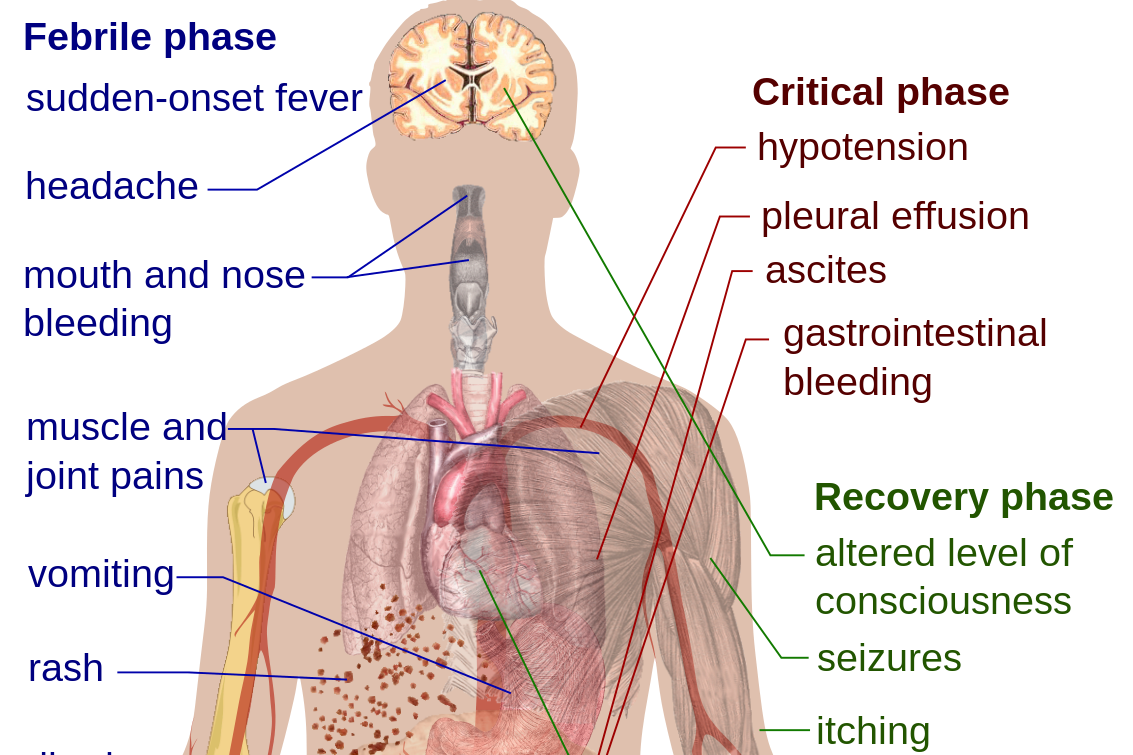 Diagram showing the main symptoms of Dengue fever, with vectors pointing at where in the body they occur