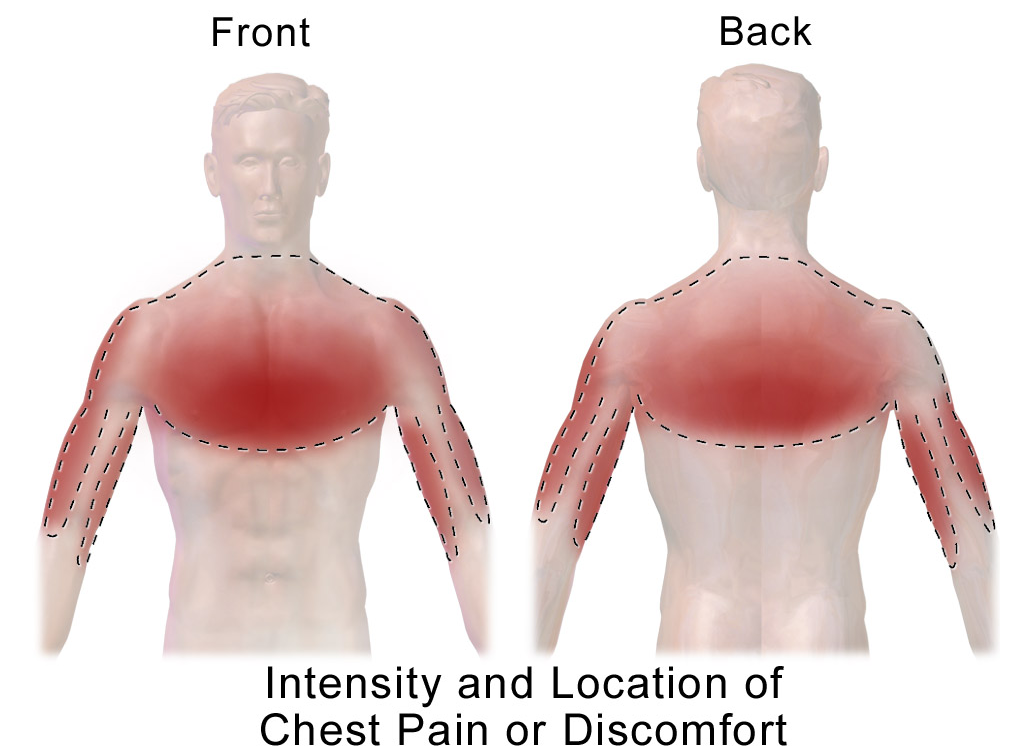 Places of Chest pain