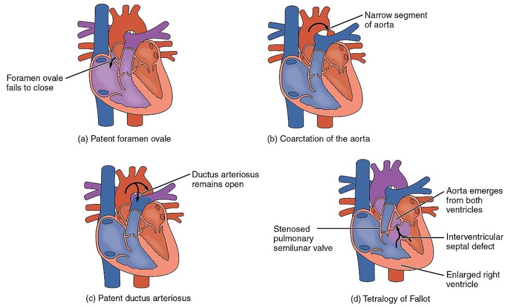 Chronic Heart defect