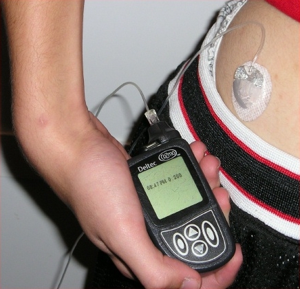 An insulin pump used to deliver appropriate levels of insulin.