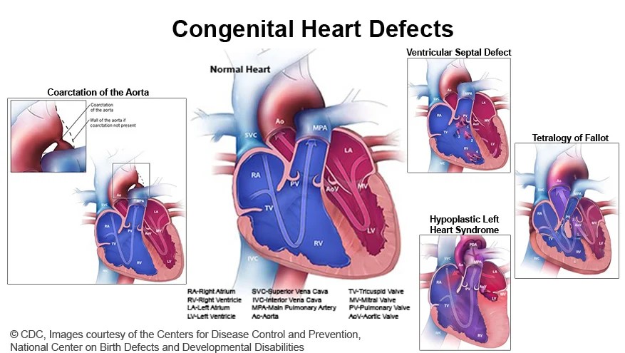 congenital-heart-defects